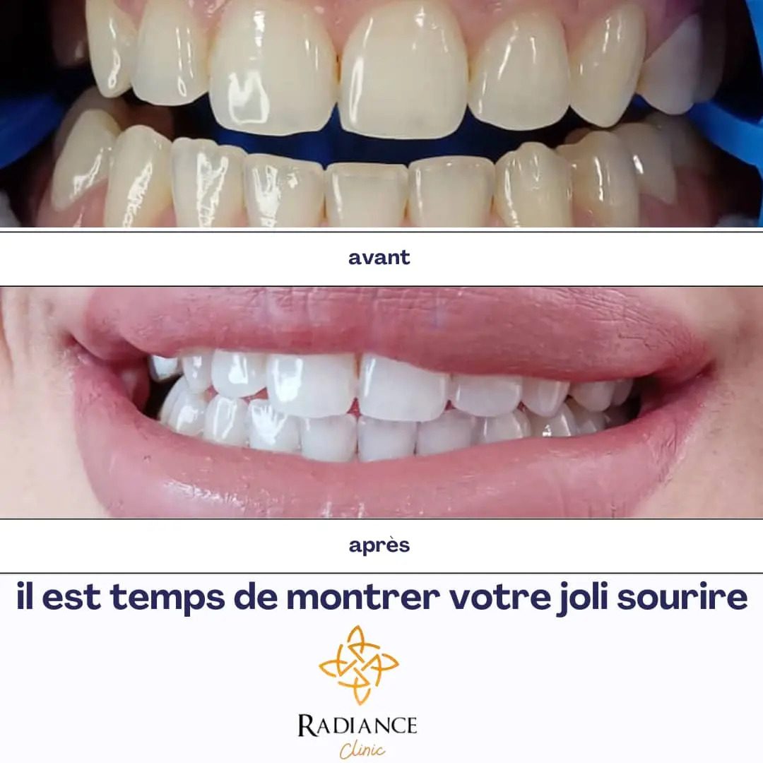 Résultat blanchiment dentaire — avant après
