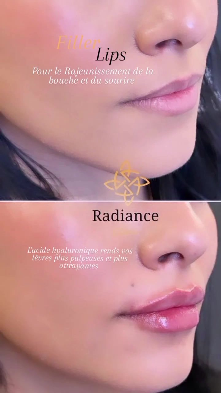 Fillers & acide hyaluronique — cabinet Radiance